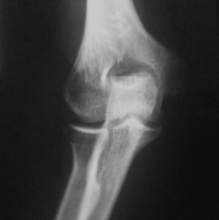 Рентгеновская денситомтерия костей