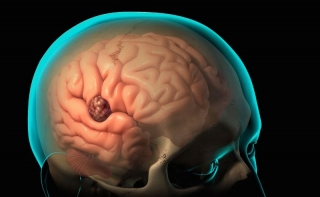 Как вовремя распознать онкологию мозга