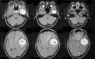 Опухоль мозга на МРТ
