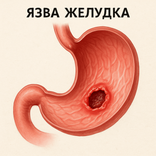 Язва желудка