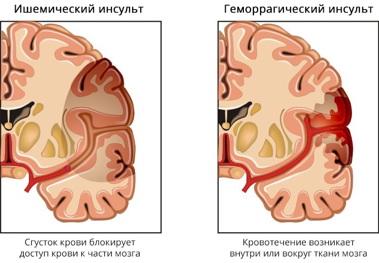 что такое сосудистая катастрофа. Смотреть фото что такое сосудистая катастрофа. Смотреть картинку что такое сосудистая катастрофа. Картинка про что такое сосудистая катастрофа. Фото что такое сосудистая катастрофа